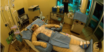 Prise en charge des grands brûlés : La vie après les flammes