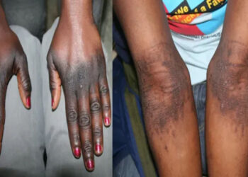 [Reportage] Dans l’intimité des accros à l’intraveineuse : «Sur 10 cas de cancer par jour, les 8 sont liés à la dépigmentation» (Suite)       