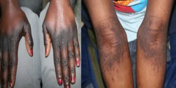 [Reportage] Dans l’intimité des accros à l’intraveineuse : «Sur 10 cas de cancer par jour, les 8 sont liés à la dépigmentation» (Suite)       