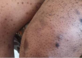 [Reportage] Mort, jambe amputée, crises… : Confessions froides de femmes (Suite)