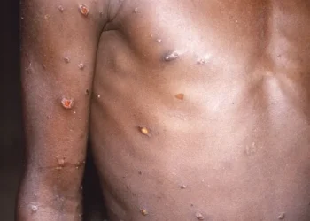 VARIOLE DU SINGE : Aucun cas au Sénégal, mais toutes les structures sanitaires et les voyageurs en alerte