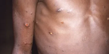 VARIOLE DU SINGE : Aucun cas au Sénégal, mais toutes les structures sanitaires et les voyageurs en alerte