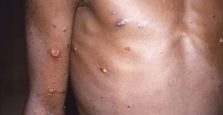 VARIOLE DU SINGE : Aucun cas au Sénégal, mais toutes les structures sanitaires et les voyageurs en alerte 1 VARIOLE DU SINGE : Aucun cas au Sénégal, mais toutes les structures sanitaires et les voyageurs en alerte