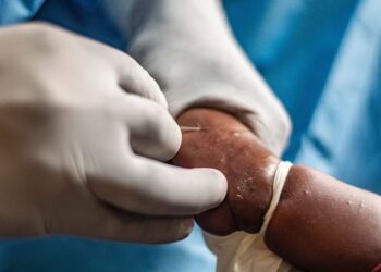 Alerte santé : La Guinée enregistre son premier cas confirmé de variole du singe