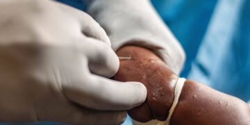 Alerte santé : La Guinée enregistre son premier cas confirmé de variole du singe