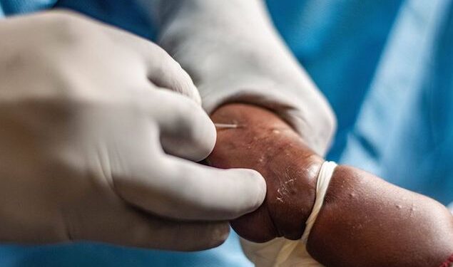 Alerte santé : La Guinée enregistre son premier cas confirmé de variole du singe 1 Alerte santé : La Guinée enregistre son premier cas confirmé de variole du singe