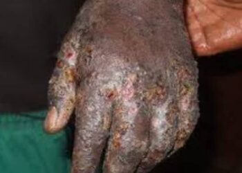 Ziguinchor : Alerte sur une recrudescence des cas de gale