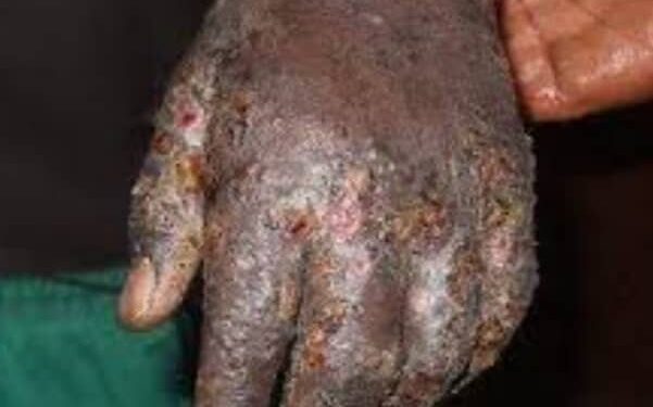 Ziguinchor : Alerte sur une recrudescence des cas de gale