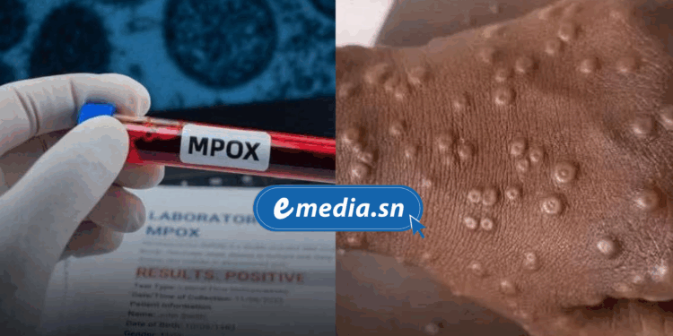 Premier cas de Mpox détecté à Dakar : un ressortissant étranger testé positif 1 20250823 173611 0000